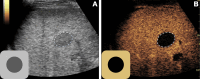 US images of a treated lesion with intralesional and perilesional
tumor viability category absent at 1 month after transarterial
chemoembolization. (A) The B-mode image is used as an anatomic reference to
define the margin of the treated lesion (dotted line), allowing separate
evaluation of contrast enhancement inside and outside of the treated lesion
margin. (B) The contrast-enhanced US image demonstrates no enhancement
within the margin of the treated lesion (dotted line) and enhancement
identical to surrounding liver along the treated lesion margin. A schematic
summarizing intralesional and perilesional findings is shown in the lower
left corner of each panel.