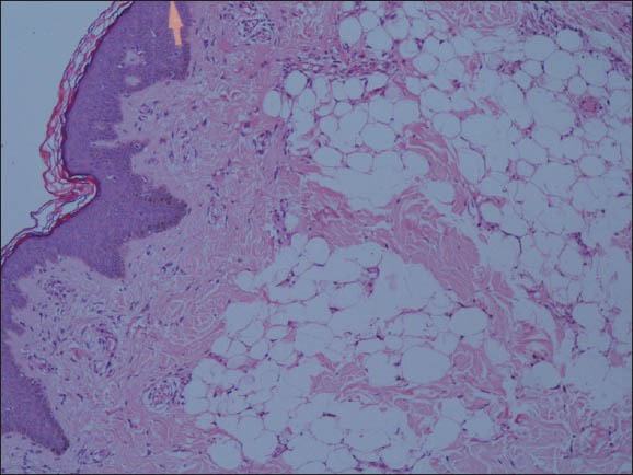 Nevus lipomatosus superficialis: A rare cutaneous hamartoma - PMC