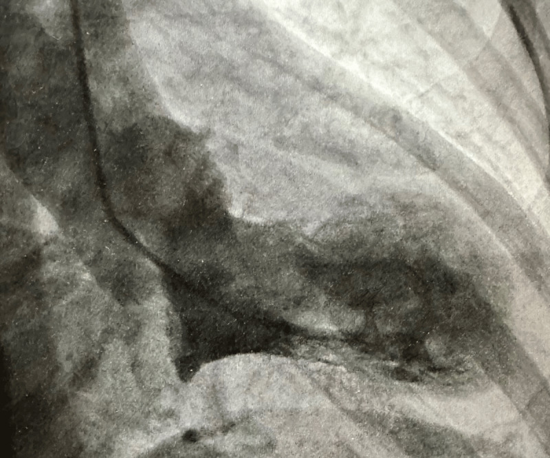 Left ventriculography showed systolic ballooning of apex with otherwise normal ventricular contraction