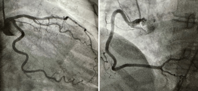 The left main and left/right coronary arteries showed minimal luminal irregularity with no significant stenosis