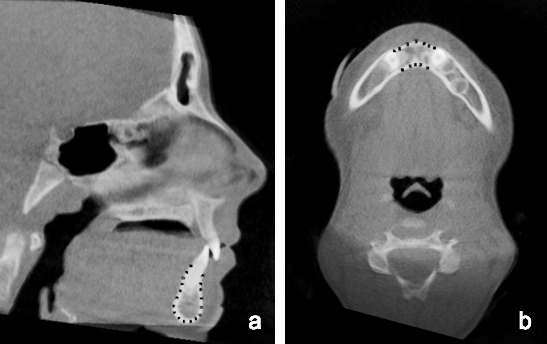 Figure 2. (a) The Anatomage area measurement tool was used to outline the visible mandibular symphysis to form a closed polygon. The y and z coordinates of each vertex were recorded and used to calculate the mandibular sagittal centroid. (b) The axial slice through the z coordinate of the mandibular centroid that was calculated in the sagittal plane was viewed, and the Anatomage area measurement tool was used to outline a closed polygon. The x and y coordinates of each vertex were recorded and used to calculate the mandibular axial centroid.