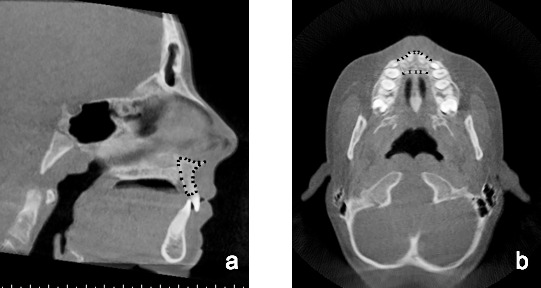 Figure 1. (a) The Anatomage area measurement tool was used to outline the premaxillary bone anterior to the premaxillary suture to form a closed polygon. The y and z coordinates of each vertex were recorded and used to calculate the maxillary sagittal centroid. (b) The axial slice through the z coordinate of the maxillary centroid that was calculated in the sagittal plane was viewed, and the Anatomage area measurement tool was used to outline a closed polygon. The x and y coordinates of each vertex were recorded and used to calculate the maxillary axial centroid.