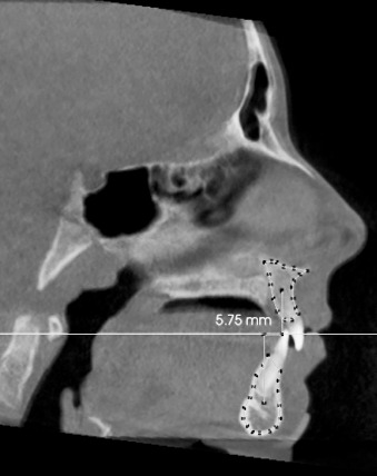 Figure 3. The overall maxillary and mandibular centroids were projected onto the midsagittal plane. True vertical lines were drawn from each centroid, and the linear distance between the two lines was calculated along the true horizontal (M measurement).