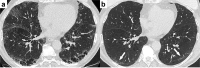 A 77-year-old woman with a 40-pack-year smoking history was admitted to the intensive care unit for SARS Cov-2 pneumonia with an oxygen saturation of 88% on room air at presentation: (a) Admission Chest CT showed paraseptal emphysema in both lower lobes and ground glass opacities (GGOs) related to SARS Cov-2 infection involving the subpleural areas of the right middle lobe, (b) CT 4-months later shows that the GGOs have resolved and the paraseptal emphysematous changes posteriorly have almost completely resolved and have been replaced by a thin linear band of what may represent fibrosis (arrows).