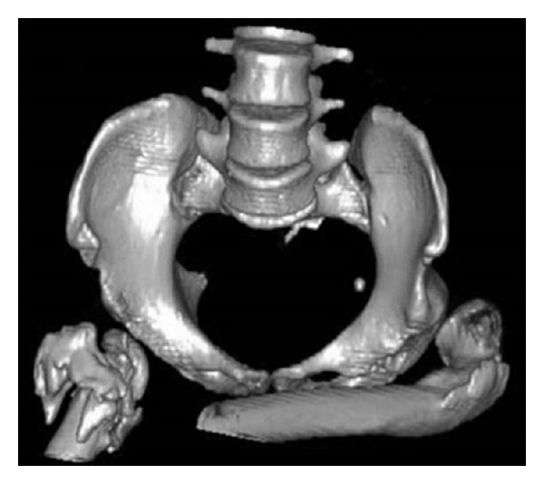 Adult Hip Flexion Contracture due to Neurological Disease: A New ...