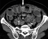 CT showing contrast-enhancing ileal NET (arrow) and mesenteric mass (arrowhead)