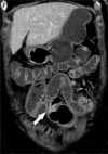 CT showing stenotic ileal loop with marked contrast-enhancing wall thickening