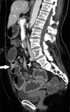 CT demonstrating stenotic ileal NET with adjacent mesenteric mass