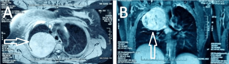 Inflammatory Myofibroblastic Tumor With Rapid Recurrence And Distant 