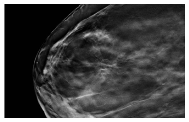 Stromal Fibrosis of the Breast: A Spectrum of Benign to Malignant ...