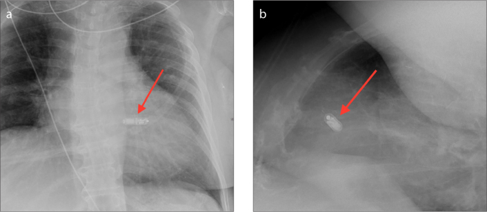 Imaging features of leadless cardiovascular devices - PMC