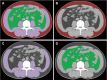 Fully convolutional neural network–based adipose and muscle tissue segmentations on abdominal CT images at the third lumbar vertebra. (A) Integrated depiction of all segmented areas. (B–D) Segmentation maps distinguish subcutaneous fat (B, highlighted in red), skeletal muscle (C, highlighted in purple), and visceral fat (D, highlighted in green). The Dice similarity coefficients stand at 0.98, 0.99, and 0.98 for subcutaneous fat, skeletal muscle, and visceral fat, respectively. (Adapted and reprinted, under a CC BY 4.0 license, from reference 105.)