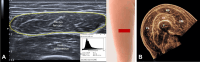 (A) Axial US imaging shows echogenicity measurement; yellow circle, region of interest; white arrowhead, the mean echogenicity value from the histogram; red rectangle, a schematic representation of the transducer’s position. (Reprinted, under a CC BY 4.0 license, from reference 32.) (B) Exemplary US image of a cross-section of the quadriceps. All quadriceps muscles (vastus medialis [VM], rectus femoris [RF], vastus lateralis [VL], vastus intermedius [VI]) were captured in a single motion. The femur (F) is also discernible within the thigh. (Adapted and reprinted, under a CCBY NC ND 4.0 license, from reference 39.)