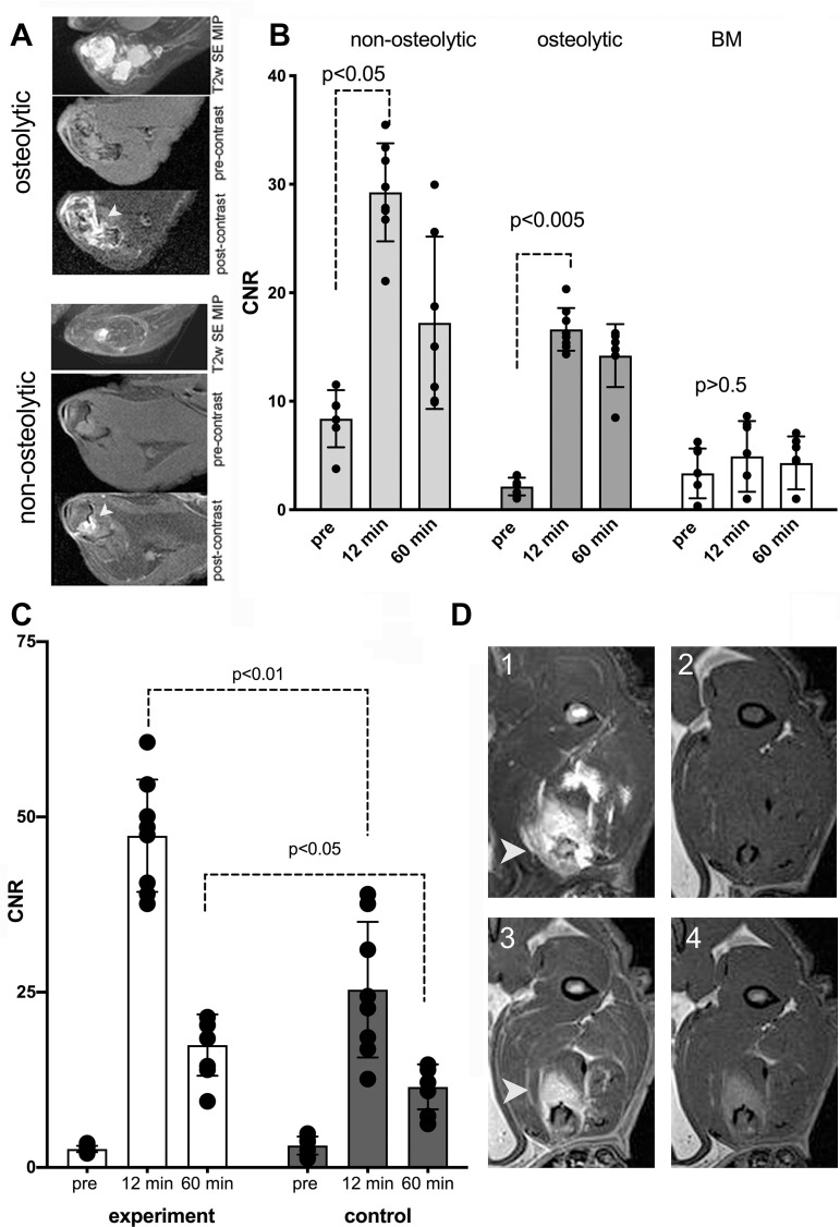 (A–D) MRI scans and graphs show osteolytic and nonosteolytic bone tumors with gadolinium(III)-mono-5-hydroxytryptamide of 2,2′,2′′-(10-(2,6-dioxotetrahydro-2H-pyran-3-yl)-1,4,7,10-tetraazacyclododecane-1,4,7-triyl)triacetic acid) (Gd-5HT-DOTAGA). (A) Comparative morphologic structure of representative osteolytic and nonosteolytic bone firefly luciferase+MDA-MB-231 tumors shown as T2-weighted (T2w) spin-echo (SE) maximum intensity pixel (MIP) projection images and T1-weighted spin-echo pulse sequence 3.0-T MRI scans acquired in-section pre-Gd-5HT-DOTAGA (pre-contrast) and after Gd-5HT-DOTAGA (post-contrast) (0.15 mmol/kg) administration. The animals were preinjected with a mixture of anti-epidermal growth factor receptor (EGFR)-F(ab’)2-horseradish peroxidase (HRP) and anti-EGFR-F(ab’)2-glucose oxidase (GOx) conjugates before Gd-5HT-DOTAGA injection. (B) Dynamic contrast enhancement in tumors (at 3.0-T MRI) expressed as contrast-to-noise (CNR) ratio. CNR of bone tumor images in animals preinjected with anti-EGFR conjugates before (pre) and 12 and 60 minutes after injection of Gd-5HT-DOTAGA. CNR in animals with CT-confirmed osteolysis and nonosteolytic tumors are shown compared with normal bone marrow (BM) enhancement. Mean data are ± standard deviation (four tumors per group, two to three MRI sections per animal). (C) CNR of tumors in experimental and control groups (three tumors per group, two to three MRI sections per animal); MRI was performed at 7.0 T. Control group animals were preinjected with a blocking dose of cetuximab (5 mg/kg) before injection of a mixture of anti-EGFR-F(ab’)2-HRP and anti-EGFR-F(ab’)2-GOx conjugates. Significant differences were observed at 12 minutes (first T1-weighted spin-echo pulse sequence acquisition) and at 60 minutes after injection of Gd-5HT-DOTAGA (0.2 mmol/kg). (D) Representative 7.0-T MRI scans of invasive tumor: (1) T2-weighted spin-echo maximum intensity pixel projection, (2) pre-Gd-5HT-DOTAGA injection T1-weighted spin echo, (3) 12 minutes after Gd-5HT-DOTAGA injection T1-weighted spin echo, (4) 60 minutes after Gd-5HT-DOTAGA injection T1-weighted spin echo. Arrowheads point to the tumor in panels A and D.