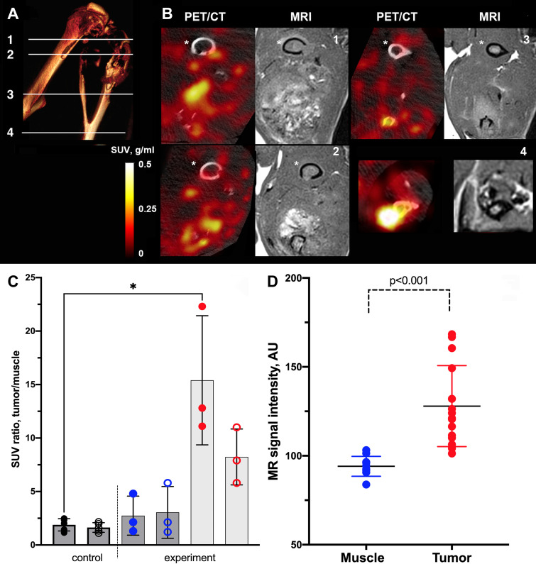 (A–D) Multimodality micro-PET/CT and 7.0-T MRI of osteolytic bone metastasis using anti–epidermal growth factor receptor (EGFR) conjugates injection followed by imaging substrate gallium 68-mono-5-hydroxytryptamide of 2,2′,2′′-(10-(2,6-dioxotetrahydro-2H-pyran-3-yl)-1,4,7,10-tetraazacyclododecane-1,4,7-triyl)triacetic acid)-(5HT-DOTAGA) and gadolinium(III)-5HT-DOTAGA, respectively, and associated graphs. (A) Three-dimensional CT reconstruction map displaying osteolysis as a consequence of MDA-MB-231 tumor growth, with imaging planes numbered. (B) PET/CT images (left) after registering to corresponding MRI sections (right) acquired at plane positions shown in A. MRI scans were used as reference to target PET/CT images for image registration purposes by using a set of landmarks (Fig E5 [supplement]). Numbers correspond to numbered imaging planes in A. * Femur. (C) PET tumor-to-muscle mean standardized uptake value (SUV) ratios (open circles) and maximum SUV ratios (filled circles) measured in total tumor volume in control group that underwent blocking anti-EGFR antibody preinjection (black circles), experimental group (blue circles), and tissue-infiltrating bone tumor fraction in experimental groups (red circles) (three tumors per group). * Statistically significant difference (Mann-Whitney nonparametric test, P < .05). (D) MRI signal intensity measured by using TW-segmentation of PET/CT images for region of interest analysis (SUV > 0.2) identified as tumor (n = 15) versus background signal intensity measured in the muscle (n = 10). Data shown as mean ± standard deviation were analyzed by using Mann-Whitney nonparametric test (P < .001). AU = arbitrary units, TW = trainable Weka.