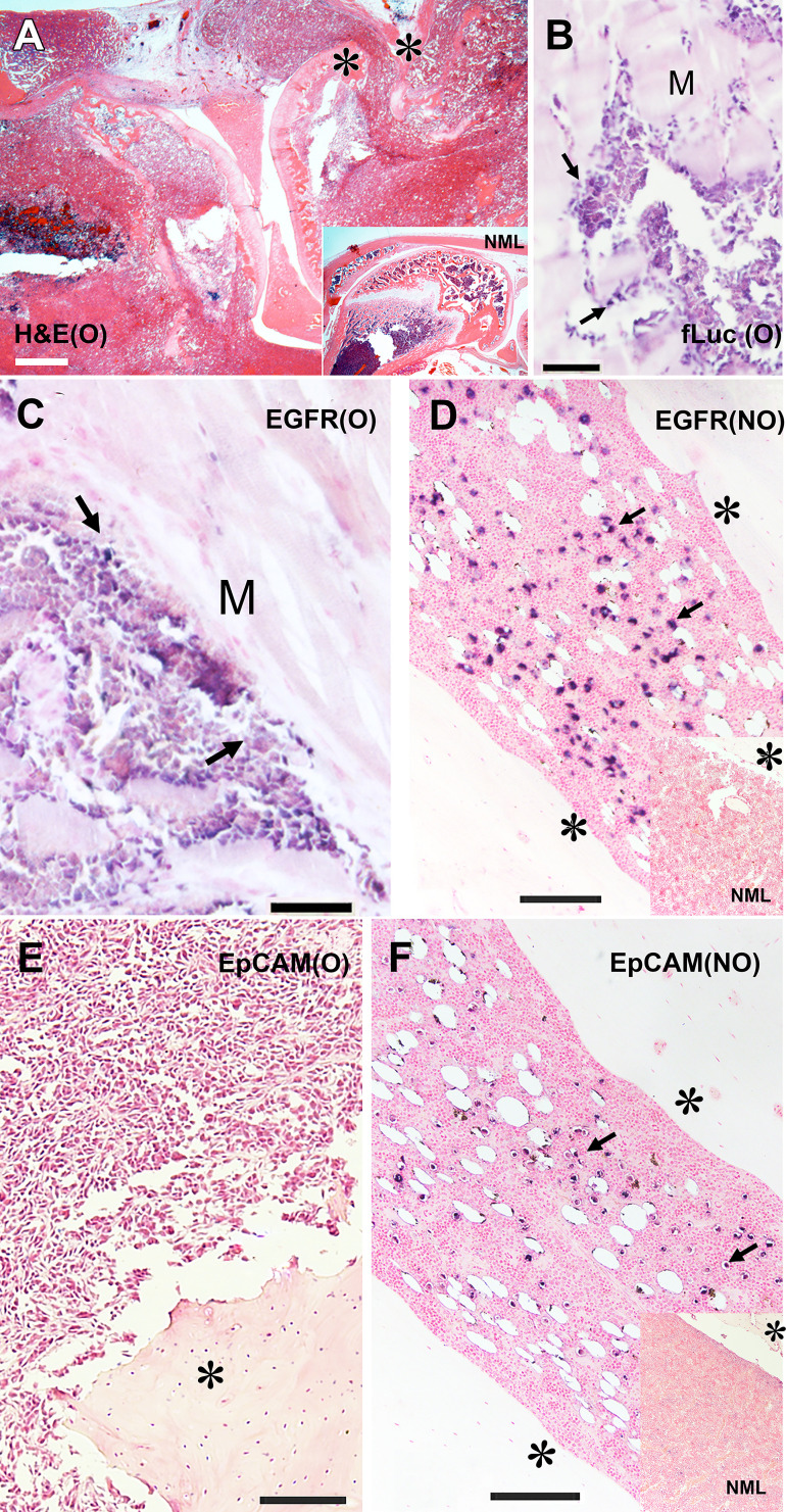 (A–F) Histologic and immunohistochemistry analysis of osteolytic (O) and nonosteolytic (NO) firefly luciferase (fLuc)+MDA-MB-231 bone metastasis models. (A) Hematoxylin-eosin (H&E) staining of decalcified knee area section of osteolytic tumor phenotype. Inset shows hematoxylin-eosin staining of a normal (NML) rat knee bone. (B) Anti–firefly luciferase immunohistochemistry staining of muscle (M) invading osteolytic tumor front (blue). (C) Anti-epidermal growth factor receptor (EGFR) immunohistochemistry staining of invading osteolytic tumor front (blue). (D) Nonosteolytic tumor dissemination in the bone marrow, anti-EGFR immunohistochemistry staining (blue). Inset, normal bone marrow section stained with anti-EGFR antibody (control animal). (E) Osteolytic tumor section immunohistochemistry staining with anti-epithelial cell adhesion molecule (EpCAM). (F) Nonosteolytic tumor section immunohistochemistry staining with anti-EpCAM antibody (blue). Inset, normal bone marrow section stained with anti-EpCAM antibody (control animal). * bone. Arrows indicate antibody-positive cells. Counterstaining (Fast Nuclear Red) bar in A, 400 µm; counterstaining bars in B–E, 200 µm.