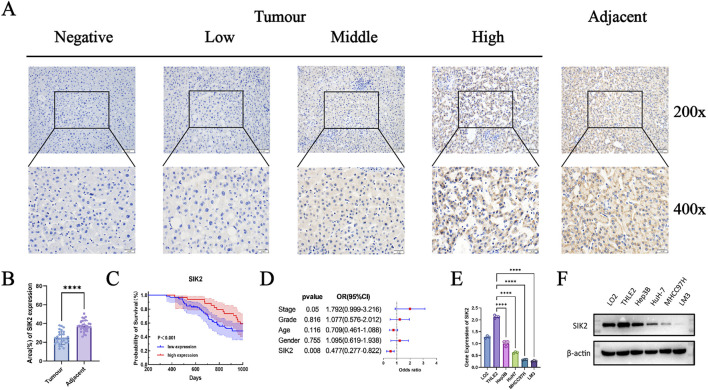 Panel A shows histological images of tissue samples with varying SIK2 expression levels at 200x and 400x magnification, labeled as Negative, Low, Middle, High, and Adjacent. Panel B is a bar graph comparing SIK2 expression in tumor and adjacent tissues, showing significant differences. Panel C presents a survival probability graph for low and high SIK2 expression groups, with high expression linked to lower survival. Panel D is a forest plot for clinical factors, showing a significant association with SIK2 expression. Panel E is a bar graph of SIK2 gene expression in different cell lines. Panel F shows a Western blot for SIK2 and β-actin across various samples.