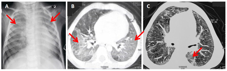 Figure 1. Chest imaging: (A) Bilateral alveolar opacities and thoracic distension on chest X-ray, (B) Diffuse ground-glass appearance on chestcomputerized tomography (CT) scan, (C) Decrease in areas of ground-glass in the lower lobes on the control chest CT scan