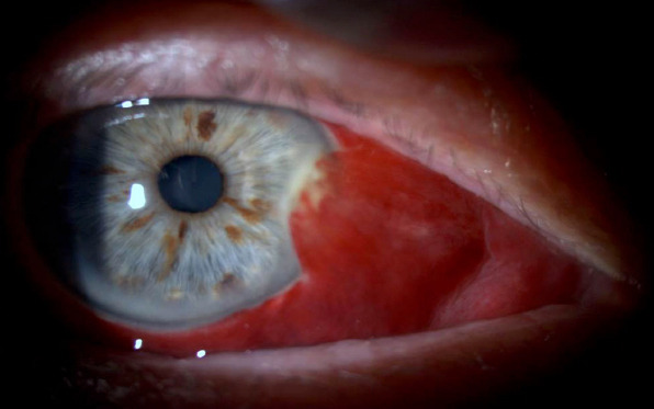 Bacterial Conjunctivitis Accompanying Spontaneous Subconjunctival 