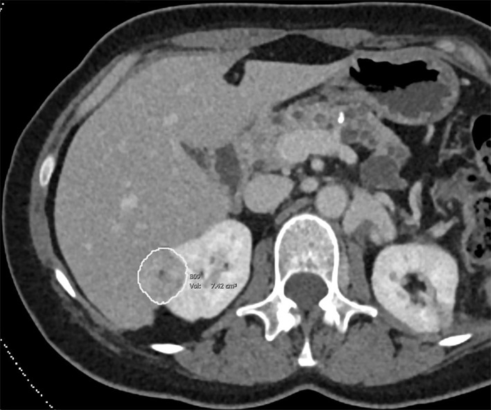 Images of clear cell renal cell carcinoma in a 55-year-old man with Von Hippel–Lindau syndrome. (a, b) Axial contrast material–enhanced nephrographic phase CT scans show the tumor was 7.4 cm3 at baseline (a) and had grown to 9.1 cm3 at 125 days (b). (c) Axial apparent diffusion coefficient (ADC) map of the tumor at baseline and (d) corresponding histogram percentile analysis.