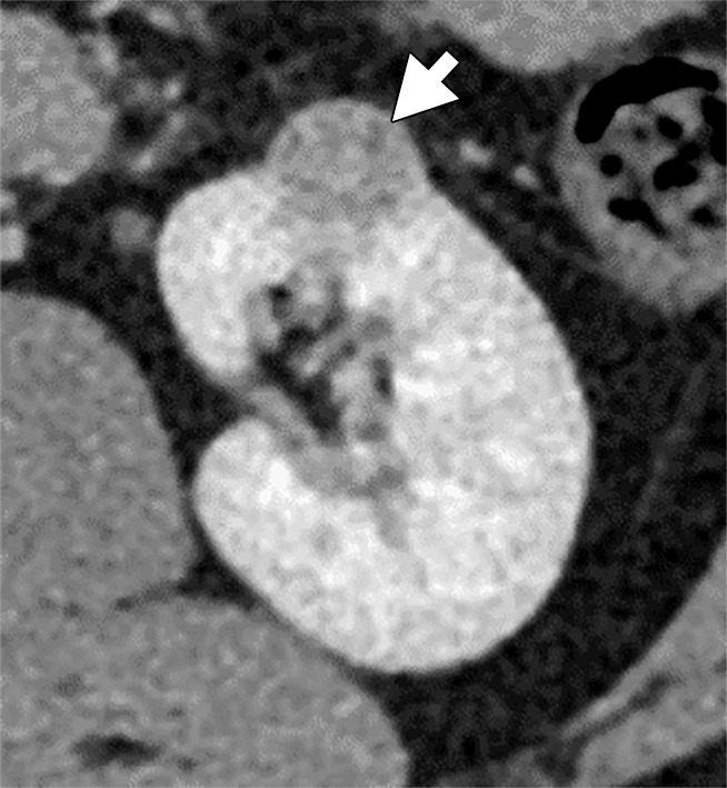 (a–c) Clear cell renal cell carcinoma (ccRCC) (arrow) in a 57-year-old man with Von Hippel–Lindau (VHL) disease that appears hypointense on (a) the baseline apparent diffusion coefficient (ADC) image (mean, 1536 × 10−6 mm2/sec) and shows 8.9 cm3 per year growth and 232-day doubling time between (b) baseline and (c) follow-up contrast-enhanced CT. (d–f) ccRCC (arrow) in a 61-year-old woman with VHL disease with a hyperintense appearance on (d) the baseline ADC image (mean, 2431 × 10−6 mm2/sec) with 2.5-cm3 per year growth and 1008-day doubling time between (e) baseline and (f) follow-up contrast-enhanced CT.