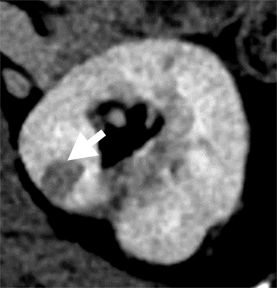 (a–c) Clear cell renal cell carcinoma (ccRCC) (arrow) in a 57-year-old man with Von Hippel–Lindau (VHL) disease that appears hypointense on (a) the baseline apparent diffusion coefficient (ADC) image (mean, 1536 × 10−6 mm2/sec) and shows 8.9 cm3 per year growth and 232-day doubling time between (b) baseline and (c) follow-up contrast-enhanced CT. (d–f) ccRCC (arrow) in a 61-year-old woman with VHL disease with a hyperintense appearance on (d) the baseline ADC image (mean, 2431 × 10−6 mm2/sec) with 2.5-cm3 per year growth and 1008-day doubling time between (e) baseline and (f) follow-up contrast-enhanced CT.