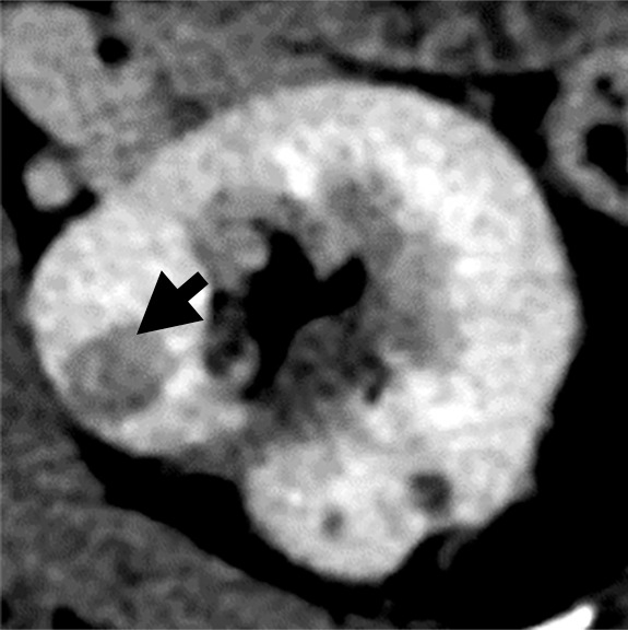 (a–c) Clear cell renal cell carcinoma (ccRCC) (arrow) in a 57-year-old man with Von Hippel–Lindau (VHL) disease that appears hypointense on (a) the baseline apparent diffusion coefficient (ADC) image (mean, 1536 × 10−6 mm2/sec) and shows 8.9 cm3 per year growth and 232-day doubling time between (b) baseline and (c) follow-up contrast-enhanced CT. (d–f) ccRCC (arrow) in a 61-year-old woman with VHL disease with a hyperintense appearance on (d) the baseline ADC image (mean, 2431 × 10−6 mm2/sec) with 2.5-cm3 per year growth and 1008-day doubling time between (e) baseline and (f) follow-up contrast-enhanced CT.