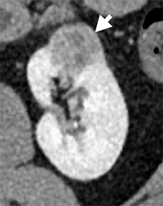 (a–c) Clear cell renal cell carcinoma (ccRCC) (arrow) in a 57-year-old man with Von Hippel–Lindau (VHL) disease that appears hypointense on (a) the baseline apparent diffusion coefficient (ADC) image (mean, 1536 × 10−6 mm2/sec) and shows 8.9 cm3 per year growth and 232-day doubling time between (b) baseline and (c) follow-up contrast-enhanced CT. (d–f) ccRCC (arrow) in a 61-year-old woman with VHL disease with a hyperintense appearance on (d) the baseline ADC image (mean, 2431 × 10−6 mm2/sec) with 2.5-cm3 per year growth and 1008-day doubling time between (e) baseline and (f) follow-up contrast-enhanced CT.