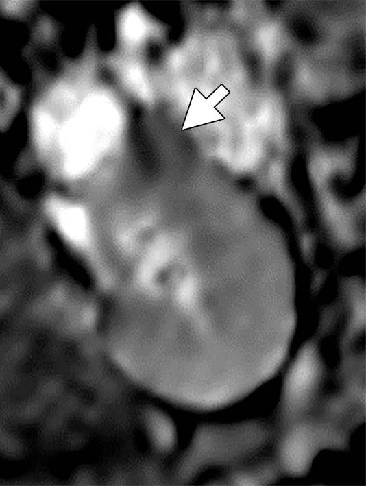 (a–c) Clear cell renal cell carcinoma (ccRCC) (arrow) in a 57-year-old man with Von Hippel–Lindau (VHL) disease that appears hypointense on (a) the baseline apparent diffusion coefficient (ADC) image (mean, 1536 × 10−6 mm2/sec) and shows 8.9 cm3 per year growth and 232-day doubling time between (b) baseline and (c) follow-up contrast-enhanced CT. (d–f) ccRCC (arrow) in a 61-year-old woman with VHL disease with a hyperintense appearance on (d) the baseline ADC image (mean, 2431 × 10−6 mm2/sec) with 2.5-cm3 per year growth and 1008-day doubling time between (e) baseline and (f) follow-up contrast-enhanced CT.