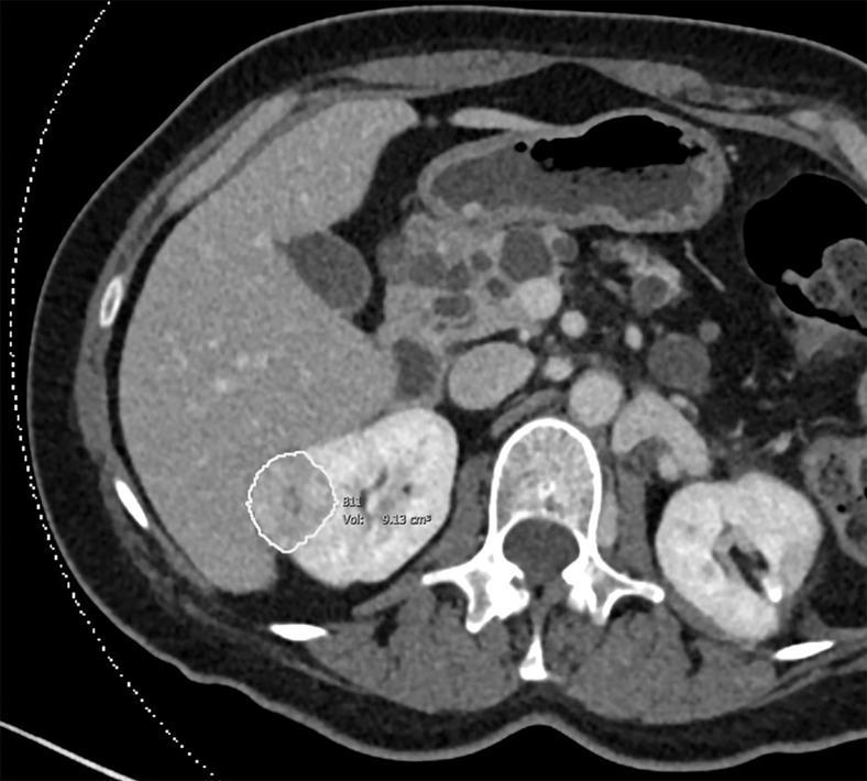 Images of clear cell renal cell carcinoma in a 55-year-old man with Von Hippel–Lindau syndrome. (a, b) Axial contrast material–enhanced nephrographic phase CT scans show the tumor was 7.4 cm3 at baseline (a) and had grown to 9.1 cm3 at 125 days (b). (c) Axial apparent diffusion coefficient (ADC) map of the tumor at baseline and (d) corresponding histogram percentile analysis.