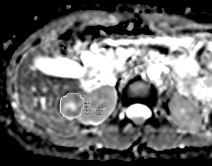 Images of clear cell renal cell carcinoma in a 55-year-old man with Von Hippel–Lindau syndrome. (a, b) Axial contrast material–enhanced nephrographic phase CT scans show the tumor was 7.4 cm3 at baseline (a) and had grown to 9.1 cm3 at 125 days (b). (c) Axial apparent diffusion coefficient (ADC) map of the tumor at baseline and (d) corresponding histogram percentile analysis.