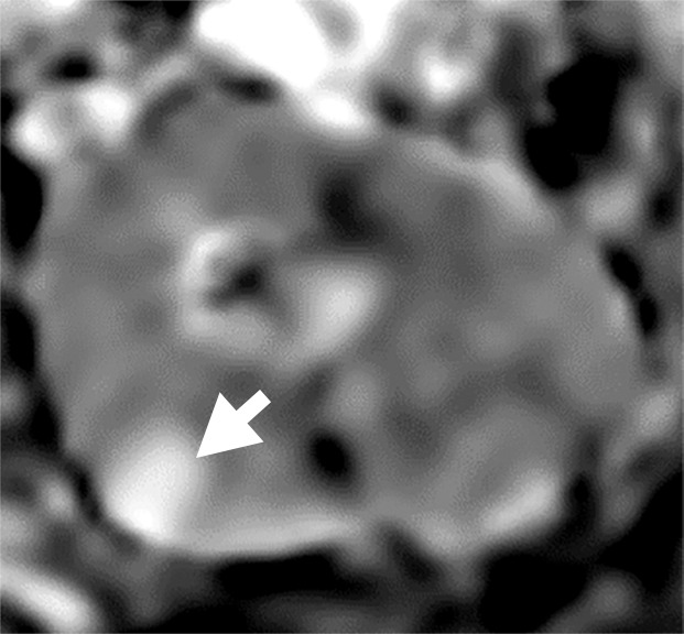 (a–c) Clear cell renal cell carcinoma (ccRCC) (arrow) in a 57-year-old man with Von Hippel–Lindau (VHL) disease that appears hypointense on (a) the baseline apparent diffusion coefficient (ADC) image (mean, 1536 × 10−6 mm2/sec) and shows 8.9 cm3 per year growth and 232-day doubling time between (b) baseline and (c) follow-up contrast-enhanced CT. (d–f) ccRCC (arrow) in a 61-year-old woman with VHL disease with a hyperintense appearance on (d) the baseline ADC image (mean, 2431 × 10−6 mm2/sec) with 2.5-cm3 per year growth and 1008-day doubling time between (e) baseline and (f) follow-up contrast-enhanced CT.