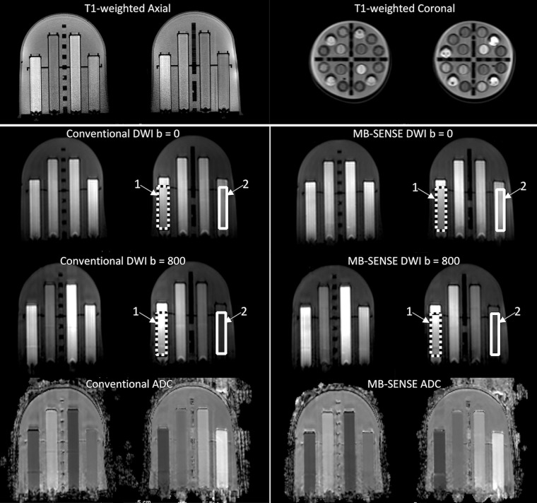 Images in a bilateral breast diffusion-weighted imaging (DWI) phantom. Shown are T1-weighted axial and coronal cross-section views (top) and representative images obtained at DWI (b = 0 and 800 sec/mm2) that depict the tumor mimic (arrow 1) and the normal tissue mimic (arrow 2) vials in the left breast used for quantitation of the ADC, contrast-to-noise ratio, and signal index. Corresponding regions of interest used for quantitation are shown for tumor tissue (dotted line) and normal tissue (solid line) mimics. ADC = apparent diffusion coefficient, MB = multiband, SENSE = sensitivity encoding.