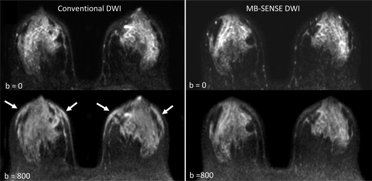 Example of differences in fat suppression observed on images obtained at MB SENSE diffusion-weighted imaging (DWI) compared with those obtained at conventional DWI. On the conventional DWI acquisition (left), unsuppressed fat signal is apparent in both anterior breasts, particularly at b = 800 sec/mm2 (arrows), which was not observed on the MB SENSE DWI acquisition (right), on which tissue contrast is higher. Two readers preferred the image quality of the MB SENSE DWI acquisition, whereas one reader rated them equally. MB = multiband, SENSE = sensitivity encoding.