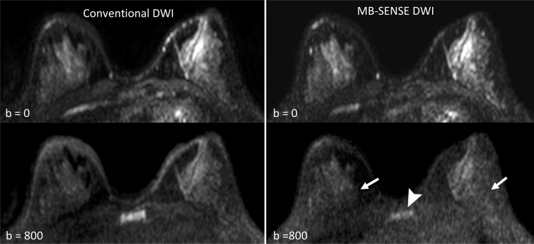 Example of differences in signal quality observed on images obtained by using MB SENSE compared with images obtained by using conventional diffusion-weighted imaging (DWI). Posterior fibroglandular tissue regions can be better evaluated on conventional DWI acquisition (left) than on the MB SENSE DWI acquisition (right) because of the reduced signal of the MB SENSE image, most apparent on b = 800 sec/mm2 (arrows). Reduced signal is also evident in the chest wall and sternum (arrowhead) for the MB SENSE acquisition compared with the conventional DWI acquisition. One reader preferred conventional DWI, whereas the other two rated the techniques as being equal. MB = multiband, SENSE = sensitivity encoding.