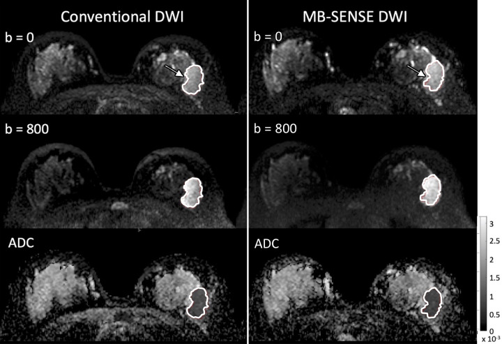 Images obtained at diffusion-weighted imaging (DWI) by using conventional (left) and MB SENSE–accelerated (right) acquisitions in a 36-year-old participant with a 43-mm grade 3 invasive ductal carcinoma (arrow, outline). Good image quality was observed (shown are b = 0 and b = 800 sec/mm2 images) on images obtained by using both sequences (with two of three readers rating them equal [0] and one preferring MB SENSE [+1]), and the resulting apparent diffusion coefficient (ADC) maps (bottom) were also very similar both qualitatively and quantitatively. The tumor mean ADC values (within the outlined regions of interest shown) were closely matched, with ADC = 0.82 and 0.86 × 10–3 mm2/sec for conventional DWI and MB SENSE DWI, respectively. MB = multiband, SENSE = sensitivity encoding.