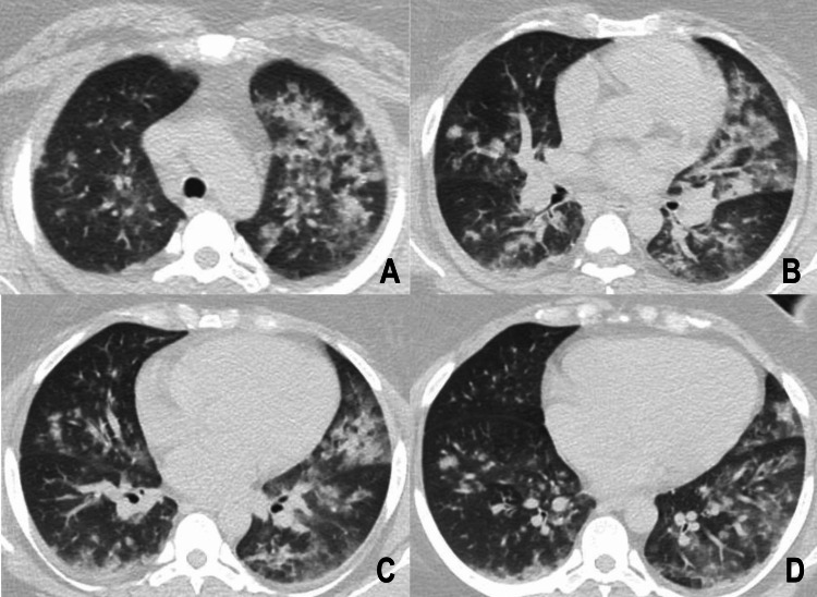 Cocaine-Induced Asthma and the 