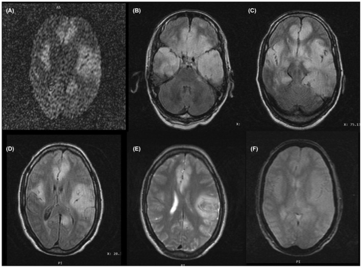 Acute disseminated encephalomyelitis and viral encephalitis: An unusual ...