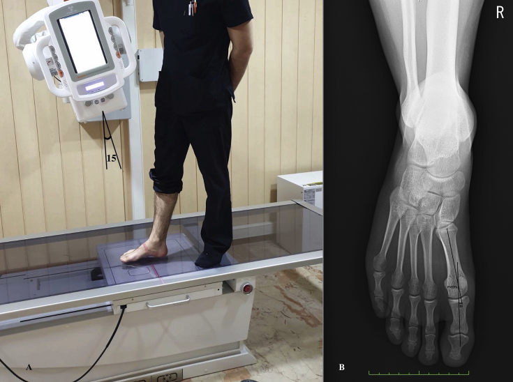 The thickness of heel fat-pad in patients with plantar fasciitis - PMC