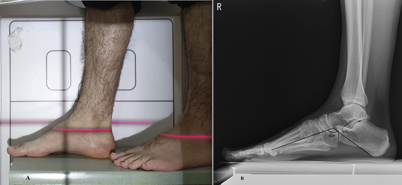 The thickness of heel fat-pad in patients with plantar fasciitis - PMC