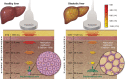 Diagrams depict the physics principles behind three PEQUS
biomarkers–attenuation coefficient (AC), backscatter coefficient, and
speed of sound (SOS)–for (left) healthy liver and (right) steatotic
liver. The color bar legend at the top right indicates ultrasound pulse
amplitude as it travels through tissue and is attenuated to a great extent in
steatotic liver (AC of 1.0 dB/cm-MHz). The inserts show the liver microstructure
that produces backscattered echo, which is greater in steatotic liver due to
hepatocytes filled and expanded by lipid vacuoles. The vertical array of numbers
on the left side of each diagram indicates the propagation depth and time of
ultrasound pulse arrival based on the SOS reported at the top of the
array.