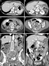 Contrast-enhanced CT images demonstrate multisite peritoneal
carcinomatosis. (A) Axial image shows implant in the fissure for ligamentum
venosum (arrow). (B) Axial image demonstrates implants in the falciform
ligament (arrow), hepatorenal recess (black arrowhead), and lesser sac
(white arrowhead). (C) Axial image illustrates implants in the central
mesentery (arrow). (D) Axial image shows implants in the small bowel
mesentery (arrow) and bowel serosa (★). (E) Coronal image
demonstrates implants in the right subdiaphragmatic region (black arrow),
large bowel serosa (white arrows), and sigmoid mesentery (★). (F)
Coronal image shows implants in the central small bowel mesentery (arrows)
and large bowel serosa (stars). No abnormal findings were seen in the
chest.