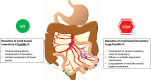 Diagram illustrates the relationship between the extent of small bowel
mesenteric and/or serosal involvement and feasibility of complete
cytoreduction. The small bowel mesentery is a large fat-laden peritoneal
reflection that attaches the jejunum and ileum to the posterior abdominal
wall via the root of small bowel mesentery. The root runs on a diagonal from
the duodenojejunal junction to the ileocecal region and contains superior
mesenteric vessels, nerves, and lymphatics.