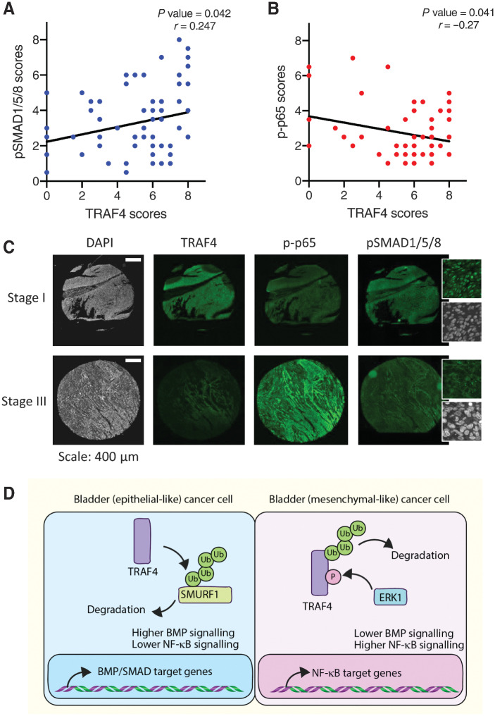 Figure 7. TRAF4 expression correlates positively with pSMAD1/5/8 levels and negatively with the p-p65 level in bladder tumors. A, Regression analysis showing the correlations between the TRAF4 expression level (score) and phospho (p)SMAD1/5/8 scores in patients with bladder cancer. Pearson χ2 test was used to determine the correlations between the TRAF4 and pSMAD1/5/8 scores. B, Regression analysis showing the correlations between the TRAF4 expression level (score) and phospho (p)-p65 score in bladder cancer patients. Pearson χ2 test was used to determine the correlations between the TRAF4 and p-p65 scores. C, Representative images of continuous sections of tissue microarray samples probed with the indicated antibodies using fluorescent IHC. The magnified insets for pSMAD1/5/8 show nuclear staining. Scale bar: 400 μm. D, Schematic representation of TRAF4 signaling dynamics in epithelial-like and mesenchymal-like bladder cancer cells. Ub denotes ubiquitin and P stands for phosphorylation of serine 334.