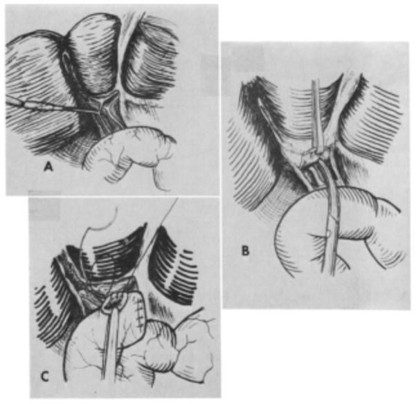 Morio Kasai: A Remarkable Impact Beyond the Kasai Procedure - PMC