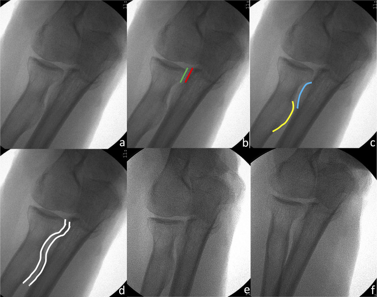 Fluoroscopy Of The Elbow: A Cadaveric Study Defining New Standard 