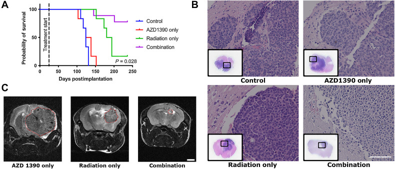 Figure 3. Effect of AZD1390 and IR on orthotopically implanted CM14 PDX in the brain. A, The Kaplan–Meier curve of animals implanted with orthotopic brain tumor. Treatment was initiated 20 days after implantation. P value of the survival of radiation only compared with combination groups is indicated. B, H&E staining of representative brain sections collected at study endpoint, from all 3 PDX tumors. Scale bars represent 100 μm. C, MRI scan of the entire mouse brain taken 134 days posttreatment, and image from one coronal section is shown here. MRI was performed for one animal in each group. No animals from the control group were alive at 134 days, and no images were acquired. Scale bars represent 2 mm.