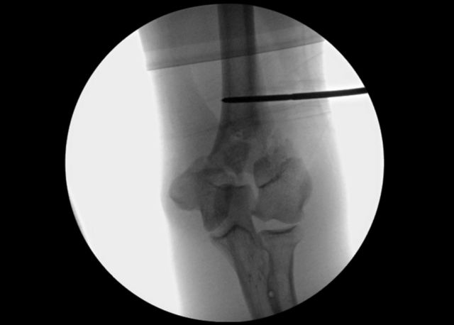 graphic file with name jbjsest-2-e09-g004.jpg