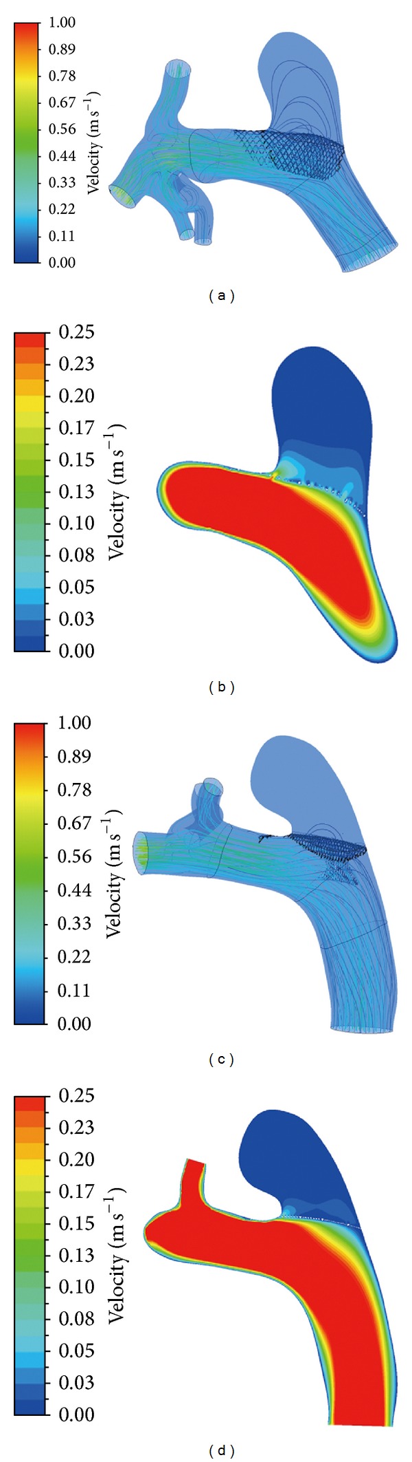 Flow Diverters for Intracranial Aneurysms - PMC