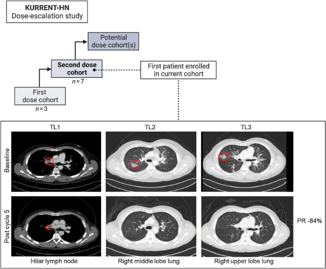 Figure 6. Overview of ongoing KURRENT-HN tipifarnib–alpelisib dose escalation study and partial response (PR) of first patient enrolled in current dose cohort. CT of a patient with PIK3CA-mutant metastatic HNSCC at baseline and after five cycles of tipifarnib and alpelisib. Target lesions (red circles) are in the hilar lymph node and right upper lobe of the lungs. Patient experienced a partial response and remains on study at time of data cut (September 2022).